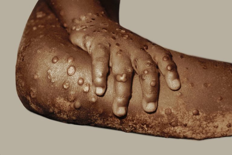 1800x1200_sciencesource_rm_monkeypox_ref_guide.jpg