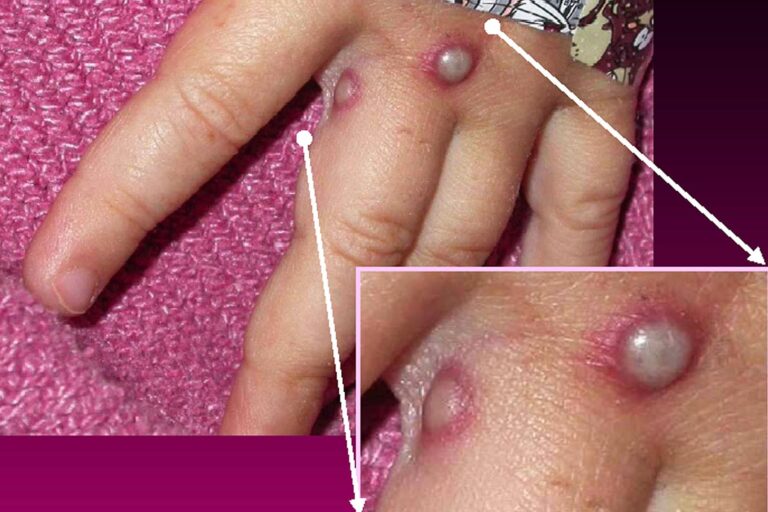 1800x1200_monkeypox_lesions_on_hand_other.jpg