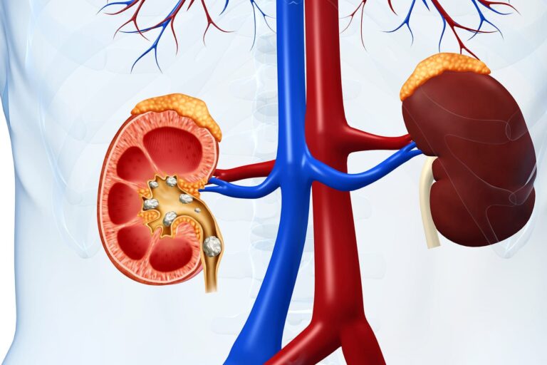 1800x1200_simple_countdown_kidney_stones_video.jpg