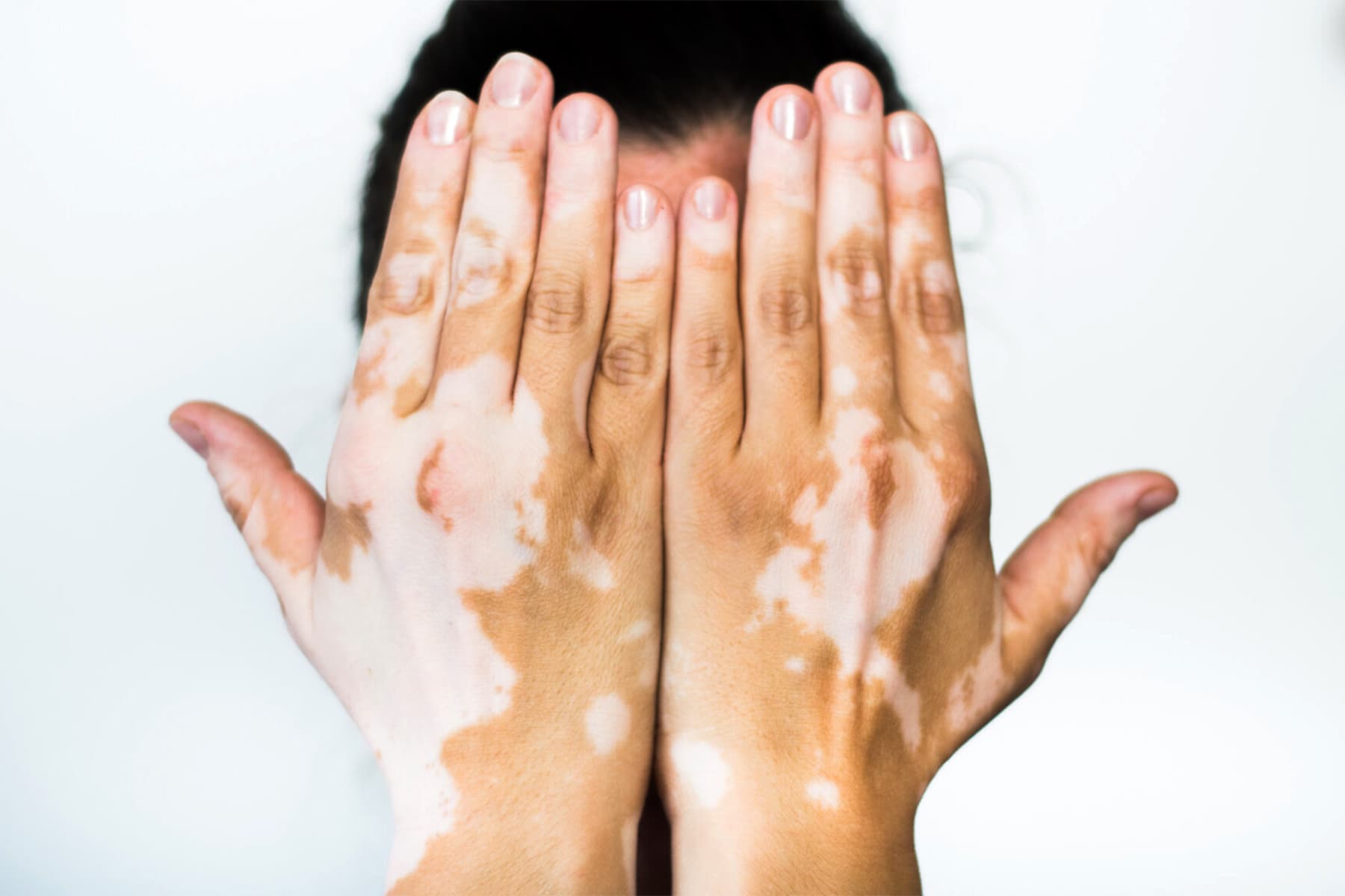 1800x1200_326053_02_roundtable_vitiligo_2_video.jpg