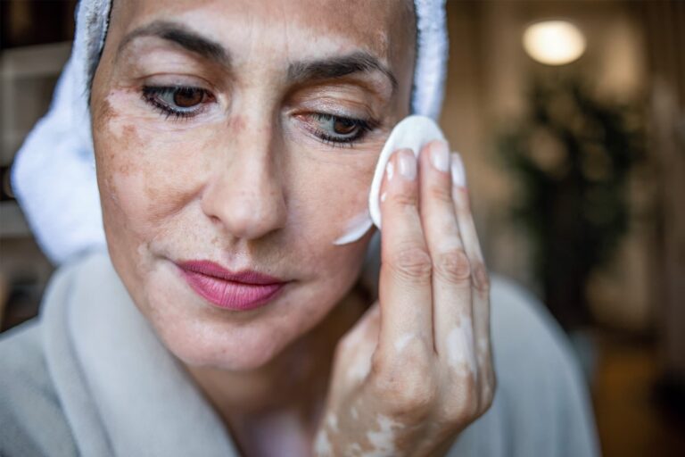 1800x1200_challenges_for_the_newly_diagnosed_vitiligo_features.jpg
