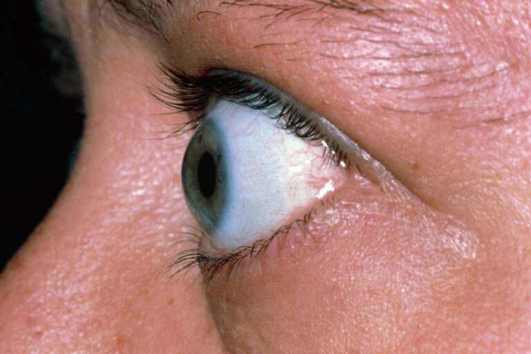 1800x1200_eyes_bulging_not_feeling_right_thyroid_eye_disease_features.jpg