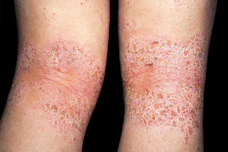 1800x1200_when_your_dry_skin_is_actually_atopic_dermatitis_features.jpg